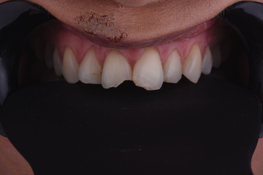 Sl. 4a: Polarizovana fotografija uz tzv. button tehniku (4b) i izrada individualnog ključa boja sa kompozitnim sistemom izbora adekvatan su način pravilnog odabira boje.