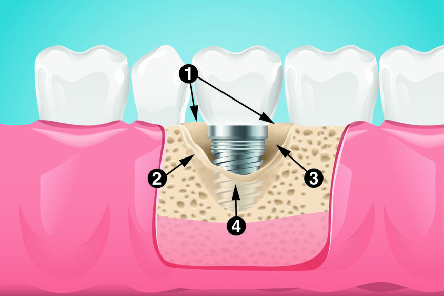 Fig 1 : PA1b : Perte osseuse < 60 % de la hauteur implantaire, défaut de 1 à 4 parois avec cratère < 3 mm.