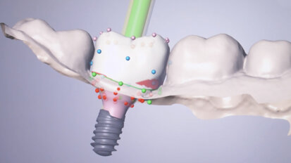 The Straumann Anatomic Healing Abutment XC as a tool for peri- implant soft-tissue management in immediate placement protocols