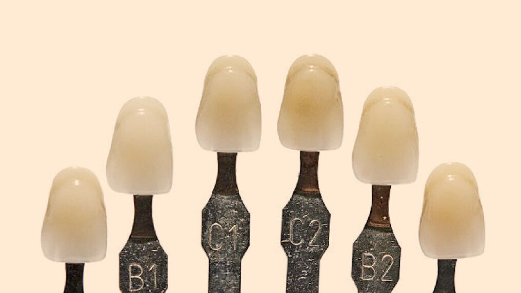 Възстановителни материали претърпяват промяна в цвета след поставянето