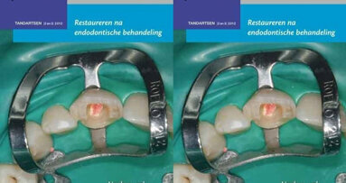 Veelbelovende aanpak bij restaureren na endodontie