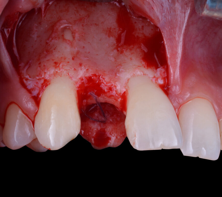 Fig. 5 - Scollamento del lembo a spessore totale.