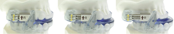 Předsunutí mandibuly a jazyka