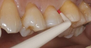 Biomateriali biomimetici nella rigenerazione dei difetti parodontali