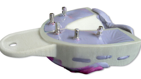 MiraTray Implant Advanced