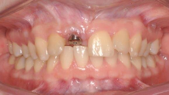 Odbudowa ubytku kostnego w szczęce allogennym blokiem kostnym z PRP