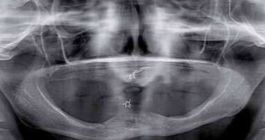 Rehabilitacja implantoprotetyczna w silnej atrofii wyrostka zębodołowego w zespole Kellego