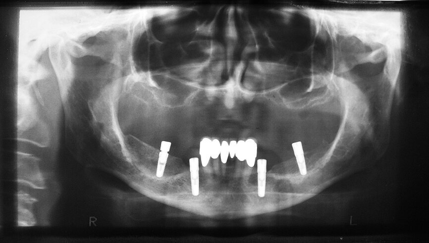 Fig. 11 : Tomographie panoramique dentaire du patient après la chirurgie aux fins du contrôle de la position des implants.