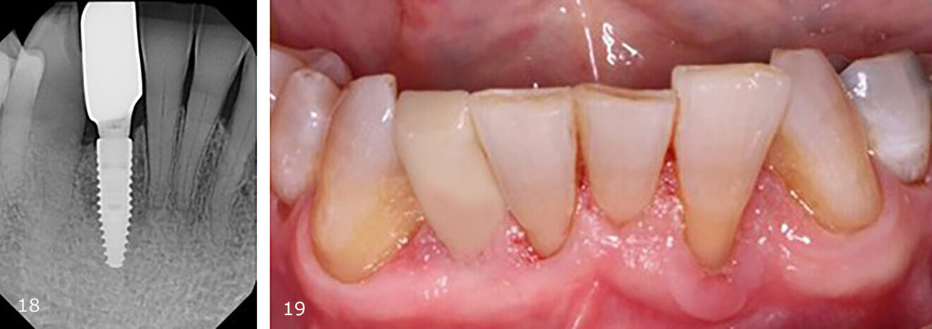 Fig. 18: Periapical radiograph of the restored implant, demonstrating good implant placement with respect to the anatomy in the narrow site. Fig. 19: Implant restoration in situ.