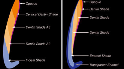 Shading technique in direct aesthetic restorations