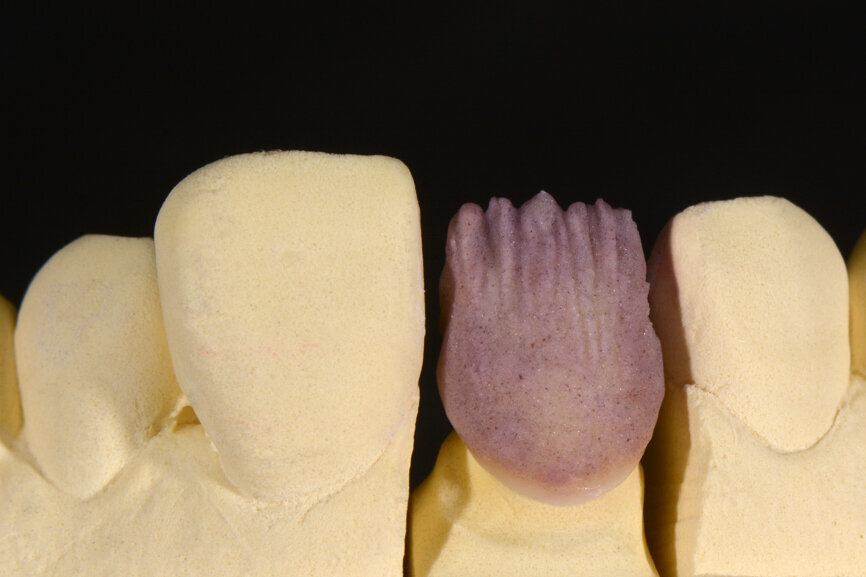 Fig. 5. Se estratificó CHROMA PLUS 2 para obtener una tonalidad cromática cálida y controlar la claridad.