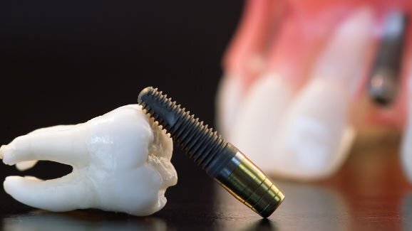 Studija otkriva nerealna očekivanja javnosti u vezi s dentalnim implantatima