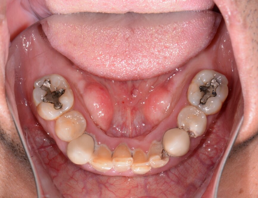 Fig. 3: Pre-op mandibular occlusal view.