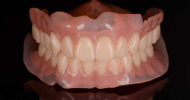 CAD/CAM complete dentures fabricated using additive and subtractive procedures