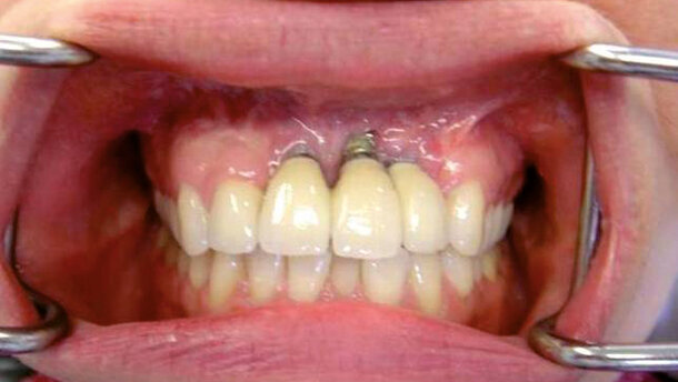 Profilassi di successo delle perimplantiti