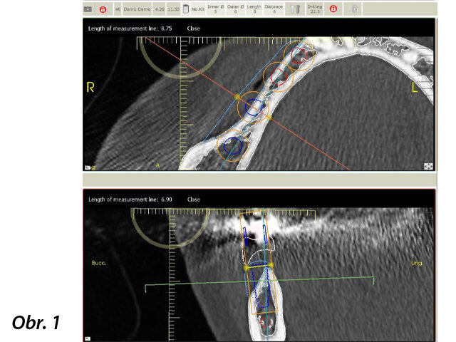 Radiologické a klinické vyšetření odhalilo omezenou dostupnost kosti.