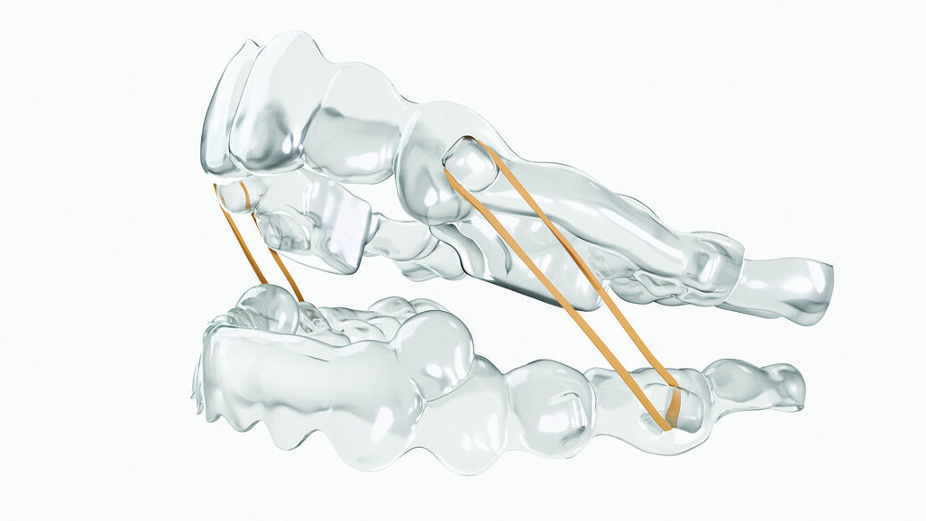 Ormco announces the launch of Spark Retainers and Spark BiteSync Class II Corrector system