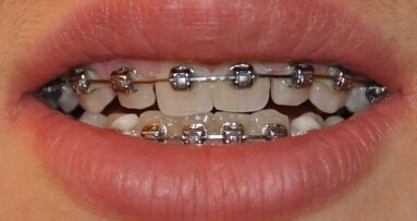 Raziskovalci  razvijajo nov izdelek dentalne nege, za oskrbo  ortodontskih pacientov