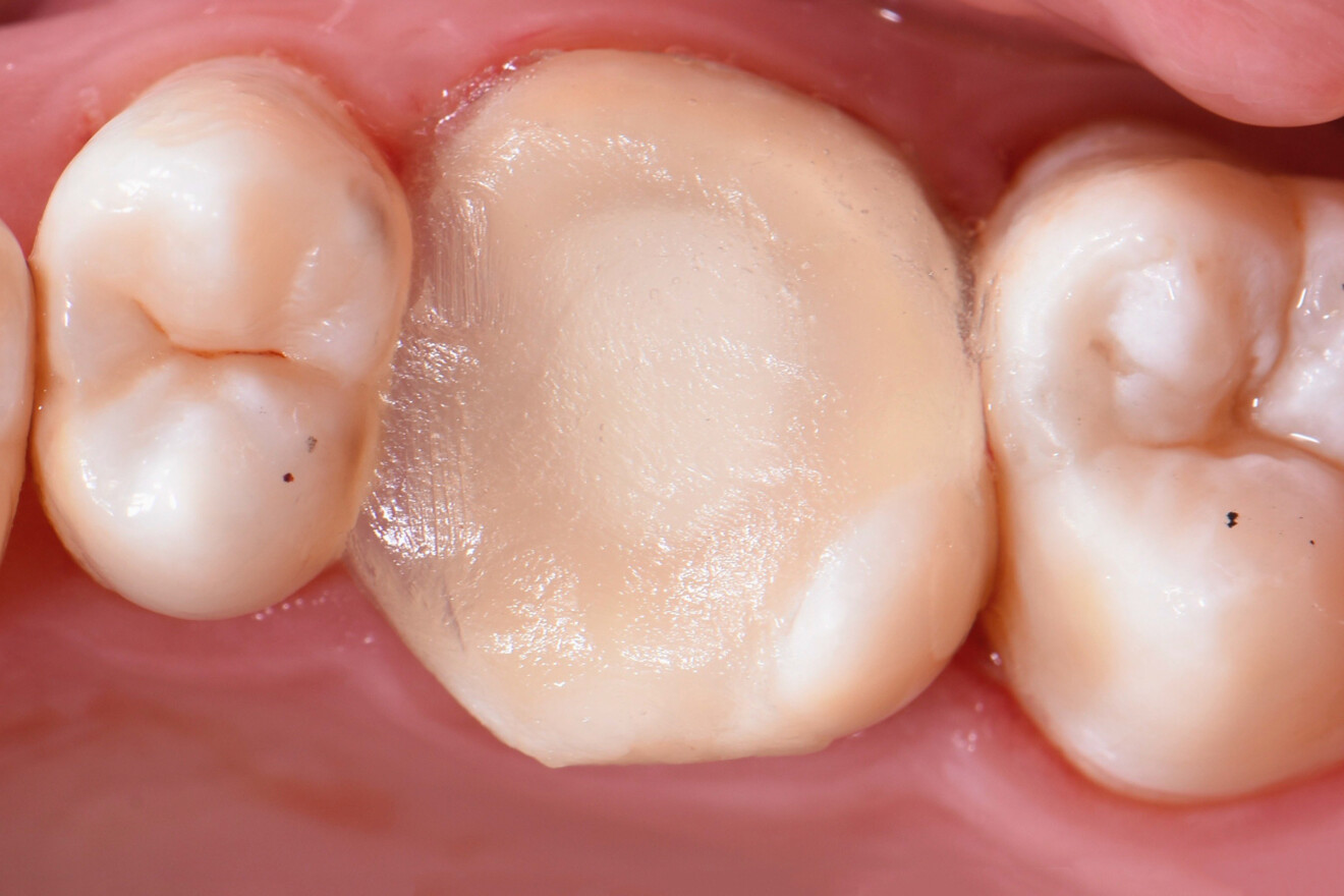 Fig. 16: White liquid dental dam showing through the temporary restoration, serving as a useful guide for the endodontist to help preserve the shape of the composite base.