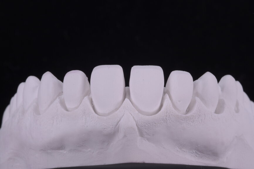 Fig. 64: Solid model
for checking contact points and positions of the veneers.