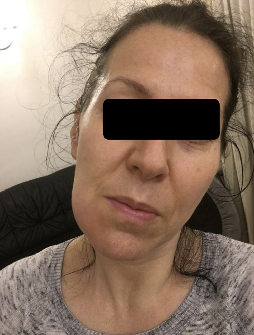 Fig. 6: Swelling of the right mandible.