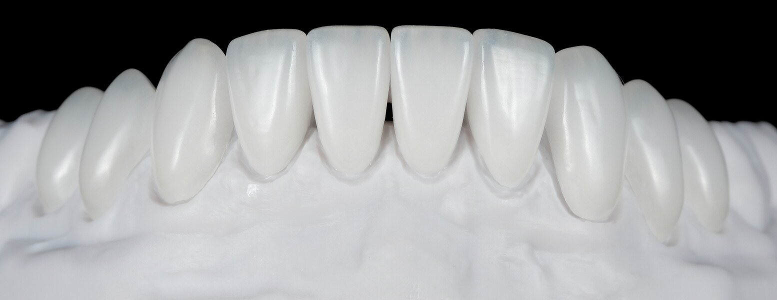 Fig. 27: Verification of passive fit and interproximal contact areas of the mandibular restorations on the model.