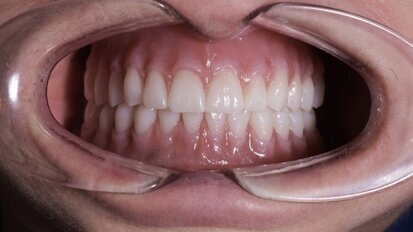 Production of complete maxillary and mandibular dentures using CAD/CAM technology