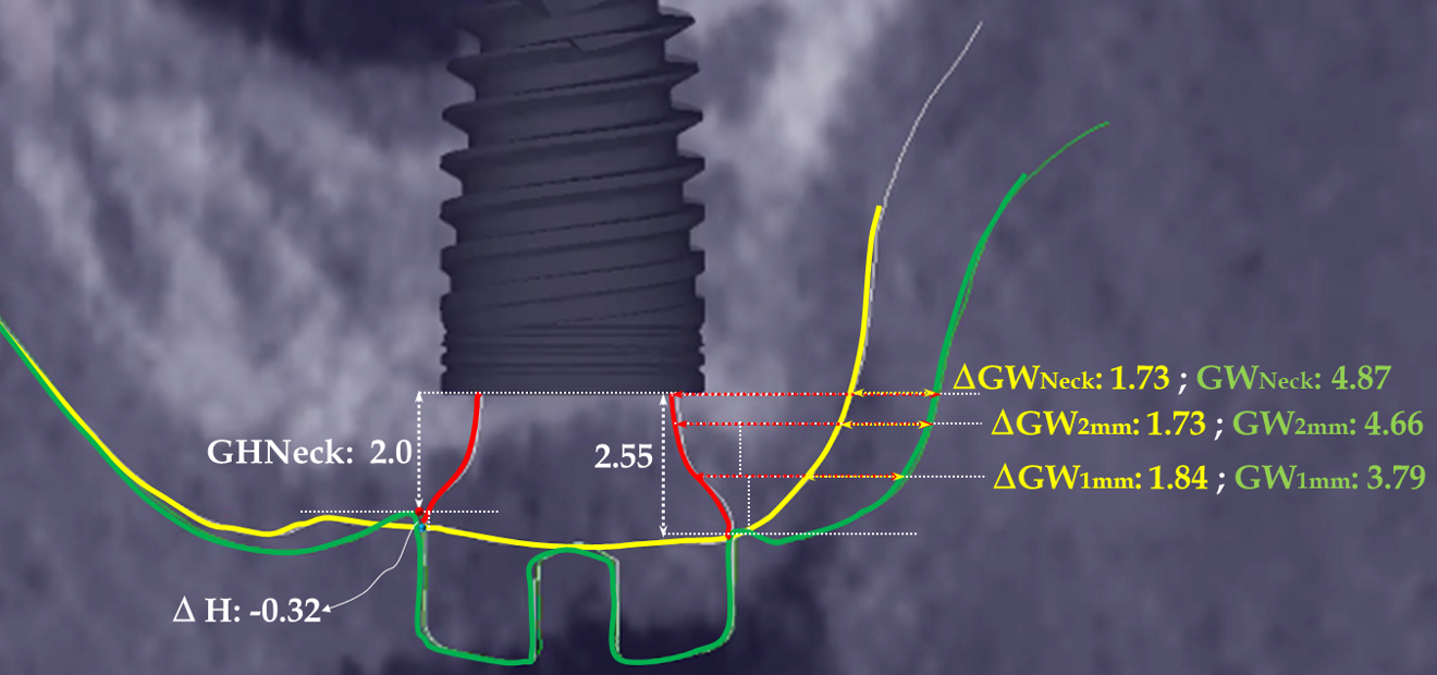 Fig. 6c: Measurement of GW by the end of healing and of the change in gingival width (∆GW) on the buccal side from before surgery until the end of the healing period. GW was measured at 1 mm (GW1mm) and 2 mm (GW2mm) from the gingival margin and at the level of the implant neck (GWNeck).