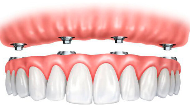 Il mercato dell Overdenture in Francia è tra i più redditizi d’Europa