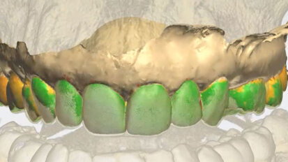 Elemento singolo in implantoprotesi in area estetica: proposta di protocollo clinico semplificato