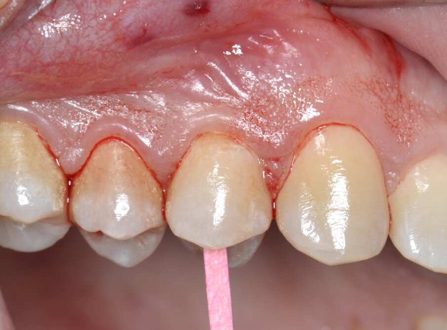 Fig. 2 - Elemento 1.4 fratturato (visione buccale).