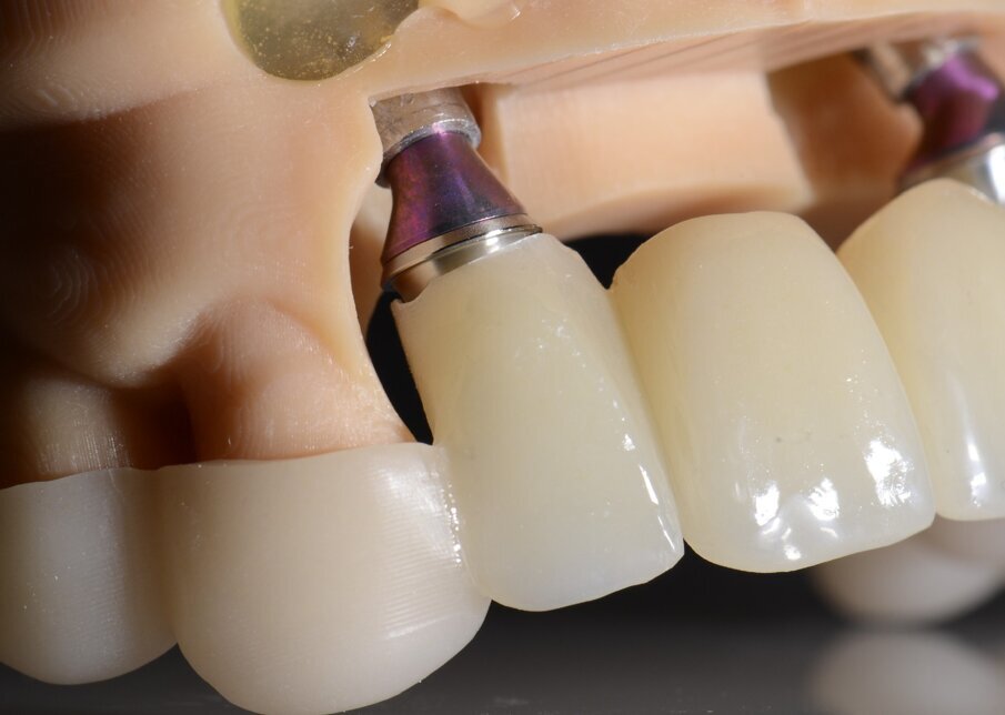 Fig. 52 - Provvisorio, SRA e variobase