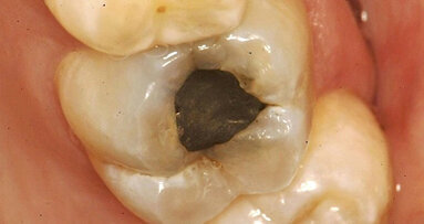 Caso clínico. Preparaciones cavitarias en lesiones restauradas con cemento  de ionómero de vidrio de alta viscosidad reforzado (Tercera parte)