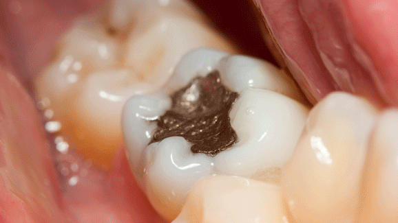 Kontra Amalgamverbot