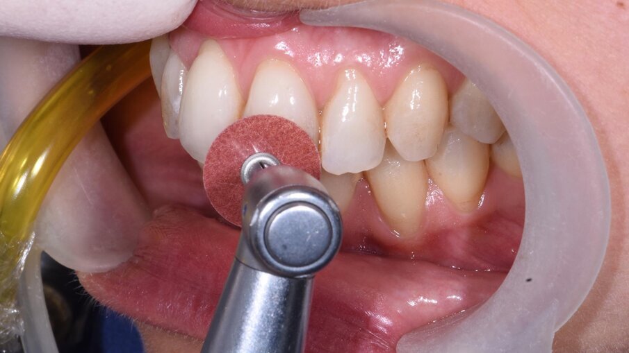 Fig. 4 - Microabrasione con disco abrasivo Sof-lex XT 3M.