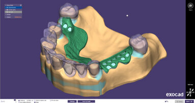 Exocad releases PartialCAD 3.0 GALWAY with advanced design features