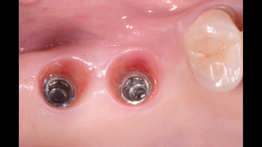 Fig. 9 - Notare l’ottimo aspetto dei tessuti molli a 6 mesi dall’inserimento implantare.