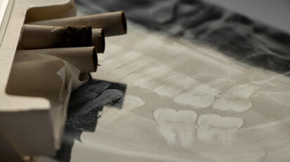 Nghiên cứu liên kết mô hình phát triển răng với tiền sử hút thuốc