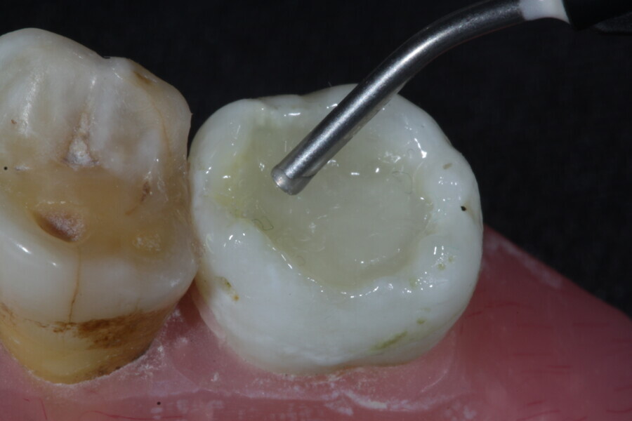 Fig. 28: A thin layer of a fibre-reinforced flowable composite (Fibrafill FLOW) is applied over the membrane cube.