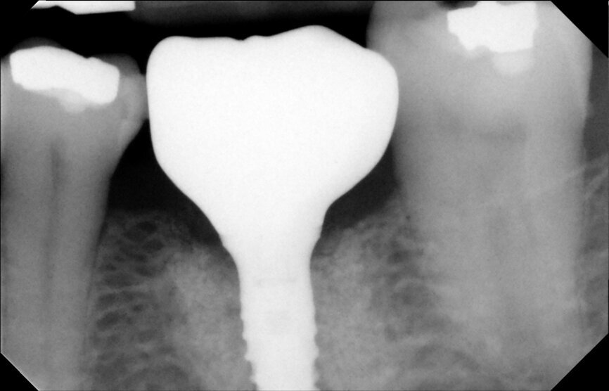 Fig. 26: Final outcome radiograph.