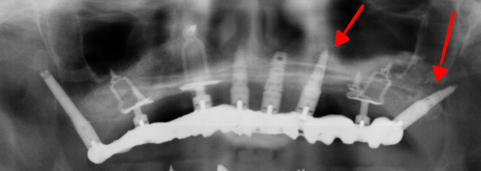 Fig. 5c : Mise en charge immédiate, avec mise en évidence de la pose de cylindres dans des zones particulièrement difficiles.