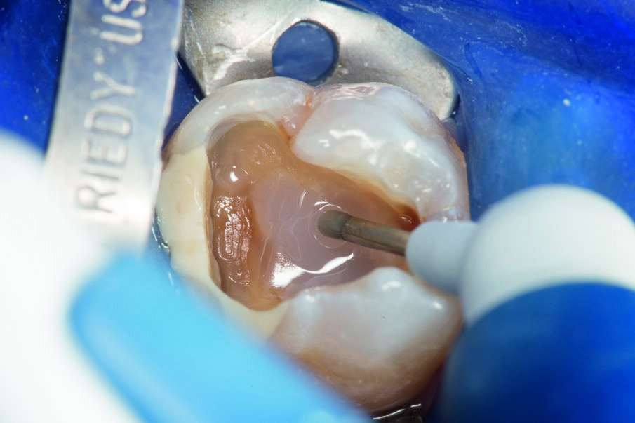 Fig. 4: First layer of SDR® Plus was placed at the cavity bottom. SDR® Plus self-levels within a few seconds and can be applied to 4mm.