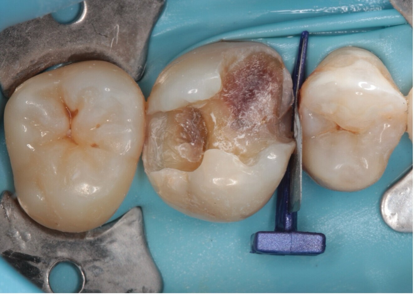 Fig. 2 : Dépose des anciennes restaurations et analyse des tissus restants.