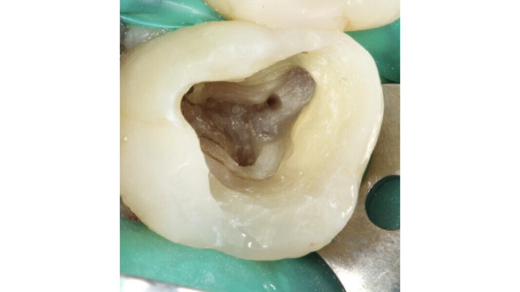 Fig. 2 : Image de la cavité d’accès réalisée, montrant l’élimination excessive de tissu sain dans la direction mésio-vestibulo-apicale.