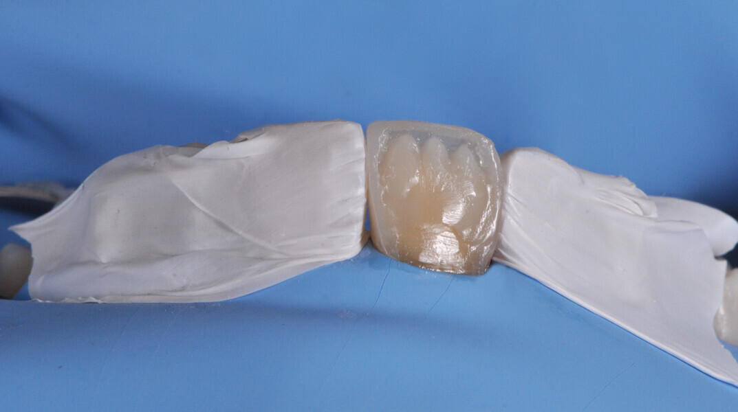Fig. 17: Isolation of the adjacent teeth with PTFE tape for a one-by-one injection.
