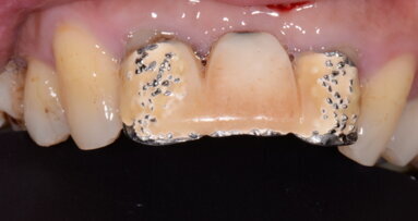 Laser diode et microchirugie