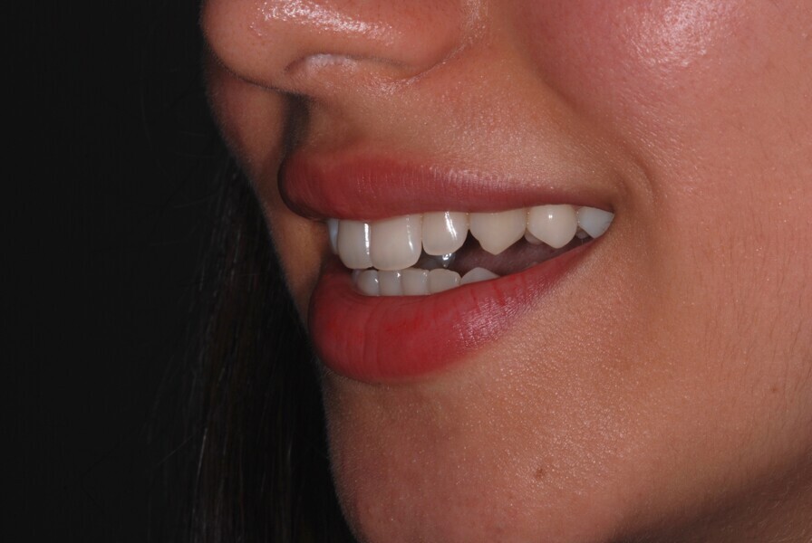 Fig. 10: Smile left side view after treatment.