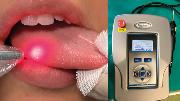 Burning Mouth Syndrome. La gestione del dolore mediante la Low Level Laser Therapy