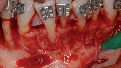 Il movimento ortodontico osteogenico e parodontalmente accelerato nel trattamento multidisciplinare implantare