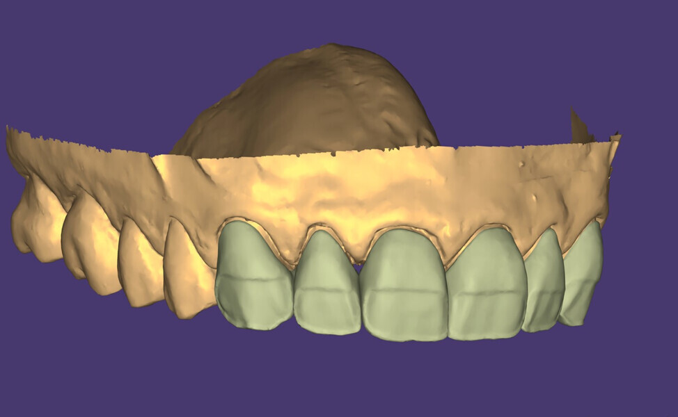 Fig. 13: Final design (with space for anterior stratification).